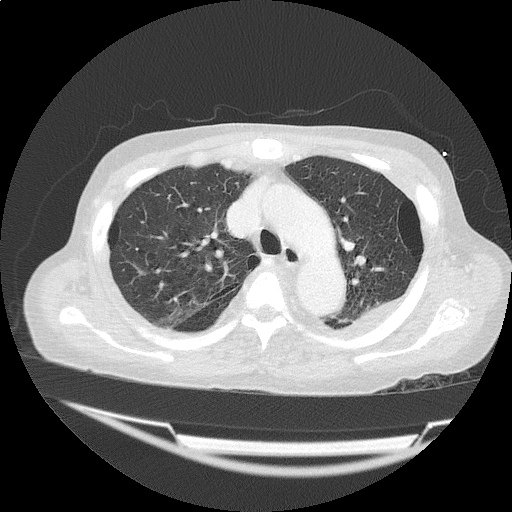 ct_chest_anemia_07
